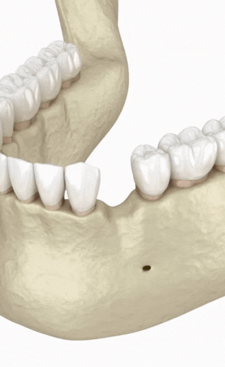 Smile Institute® BLOG - Minden, amit a csontpótlásról tudni érdemes
