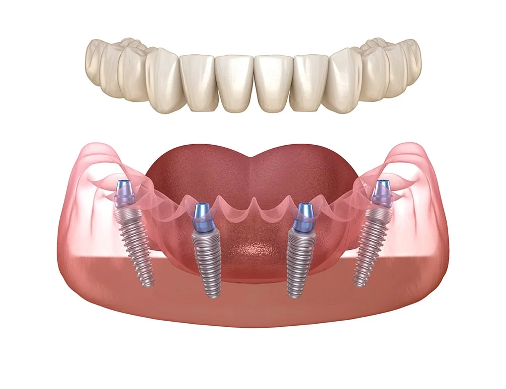 Smile Institute® - All-on-4 ® implantátum fogpótlások Smile Institute® - All-on-4 ® implantátum fogpótlások