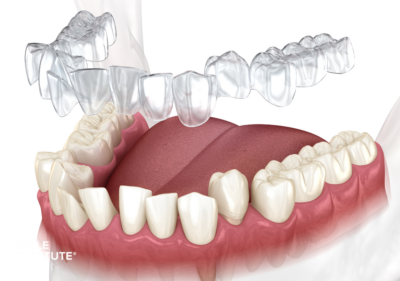 Smile Institute® BLOG - Jelek, hogy az Invisalign® működik