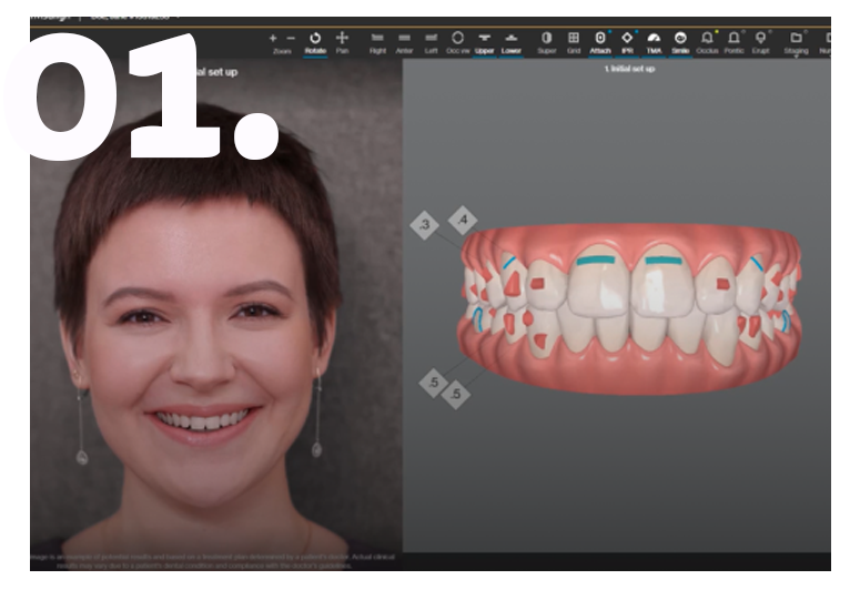 Smile Institute - Invisalign láthatatlan fogszabályzás kezelés