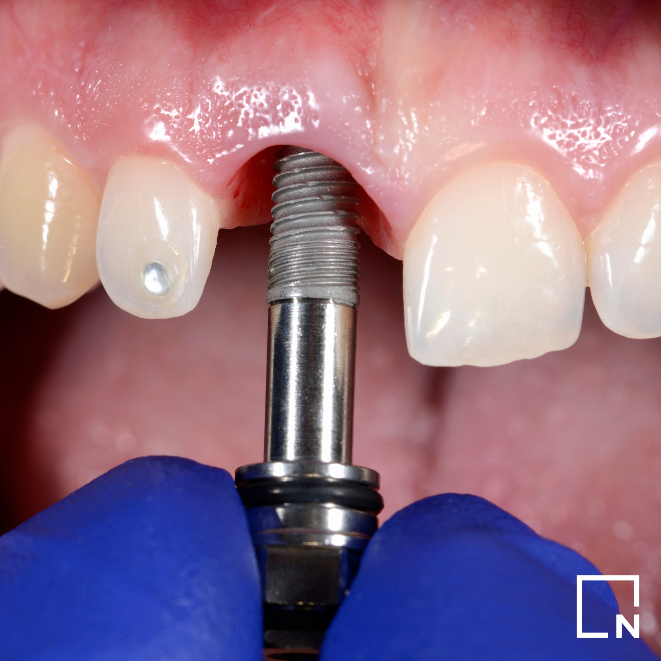 Smile Institute® BLOG - 15+1 fontos tény az implantációs kezelésről