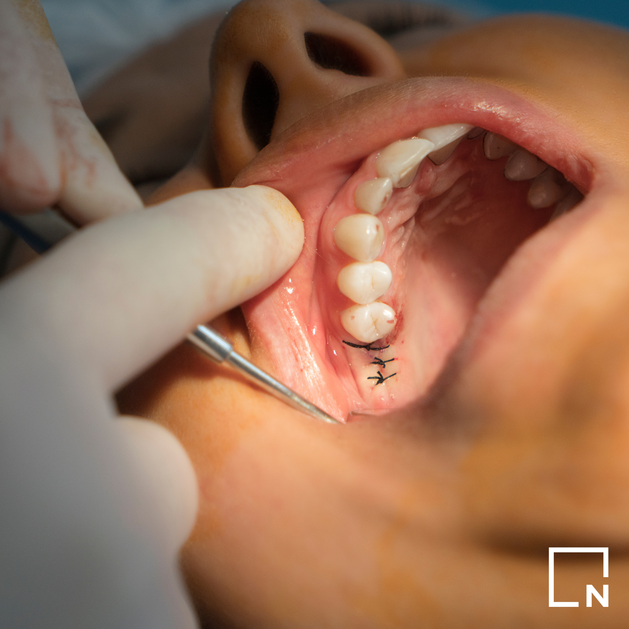 Smile Institute® BLOG - 15+1 fontos tény az implantációs kezelésről