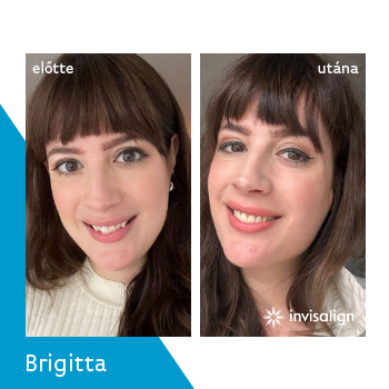 Smile Institute - Invisalign eredmények