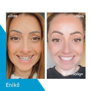 Smile Institute - Invisalign eredmények