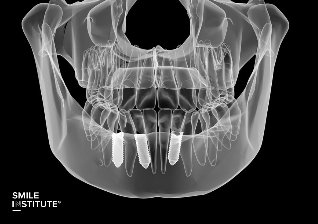 Smile Institute® BLOG - Hogyan támogatja a csontpótlás a fogimplantátumokat?