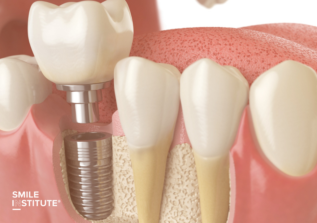 Smile Institute® BLOG - Hogyan támogatja a csontpótlás a fogimplantátumokat?