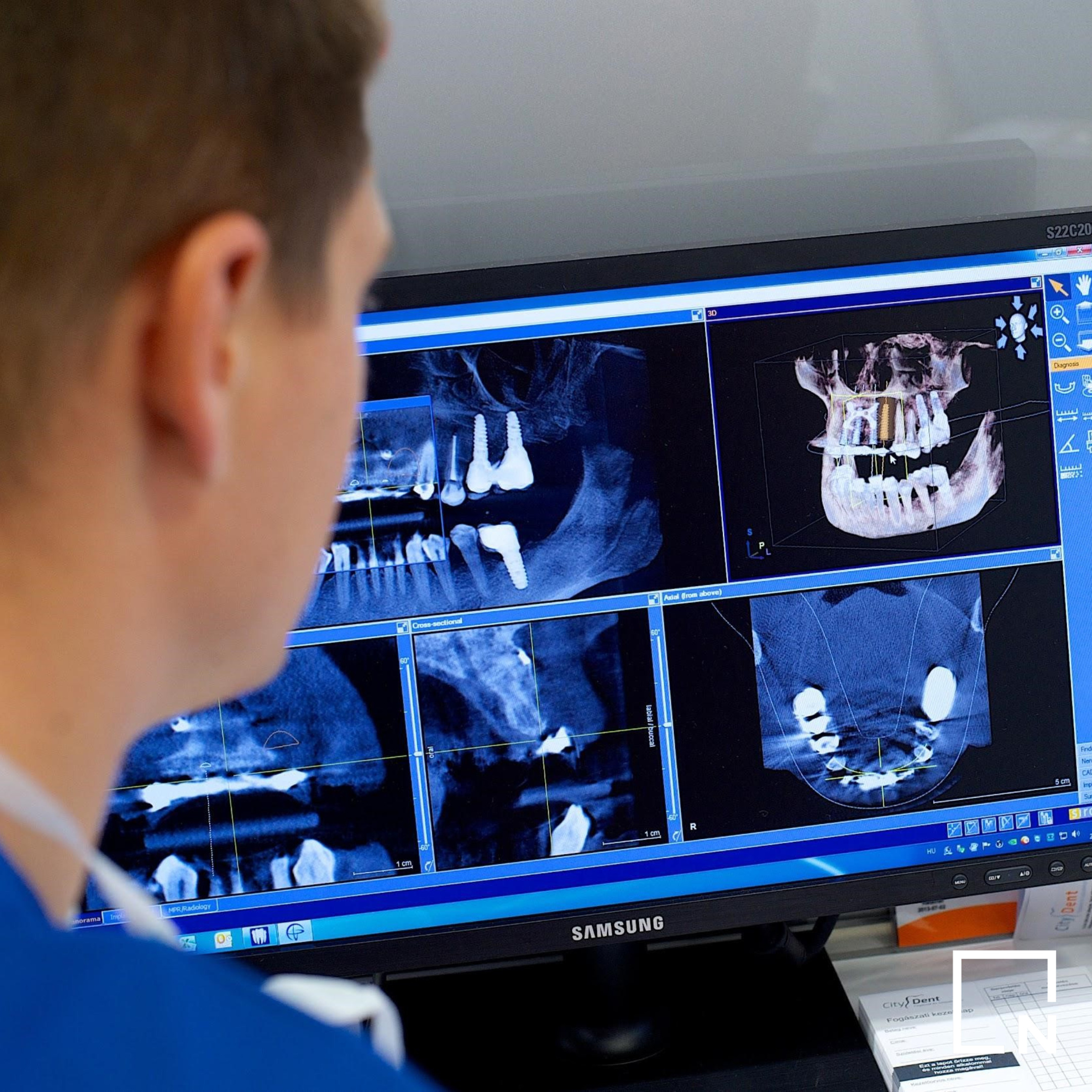 Smile Institute® BLOG - 15+1 fontos tény az implantációs kezelésről