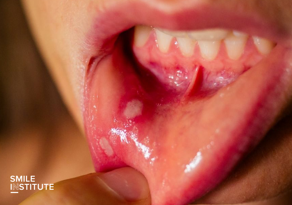 Smile Institute® - Gyakori téli problémák, amelyek a szájrák korai „figyelmeztető jelei” lehetnek