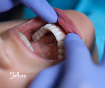 Smile Institute® - Fogászati implantátum: Miért érdemes befektetni a tartós mosolyba?
