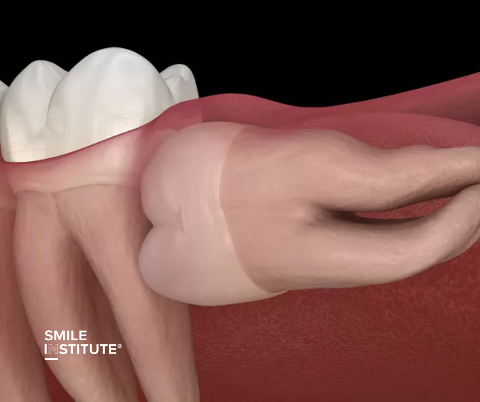 Smile Institute® - Miért fontos a fogászati CT felvétel készítése bölcsességfog eltávolítás előtt?