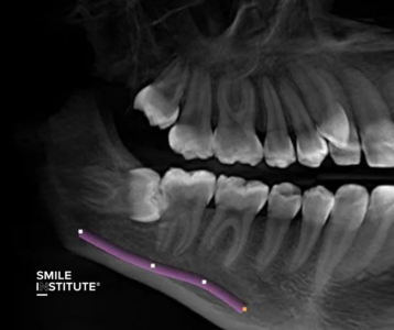 Smile Institute® - Miért fontos a fogászati CT felvétel készítése bölcsességfog eltávolítás előtt?