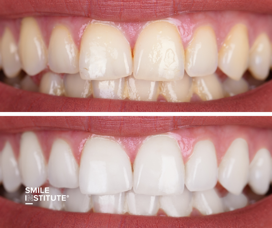 SI-Rendeloi-fogfeherites-1 Smile Institute Blog - Fogfehérítés nyár előtt – Miért éri meg a rendelői eljárást választani?
