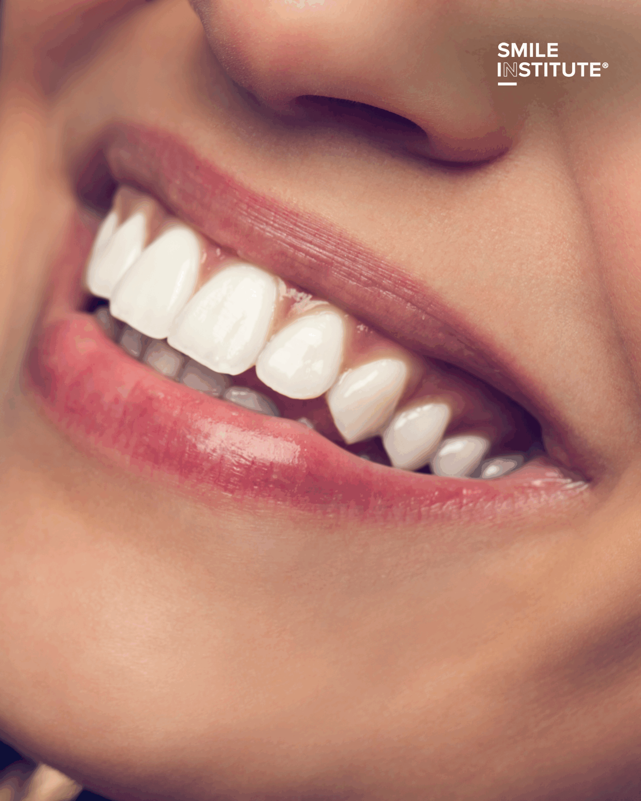 Teljeskörű mosolyátalakítás – így hozza vissza a ragyogó mosolyát! - Smile Institute Blog Teljeskörű mosolyátalakítás – így hozza vissza a ragyogó mosolyát! - Smile Institute Blog