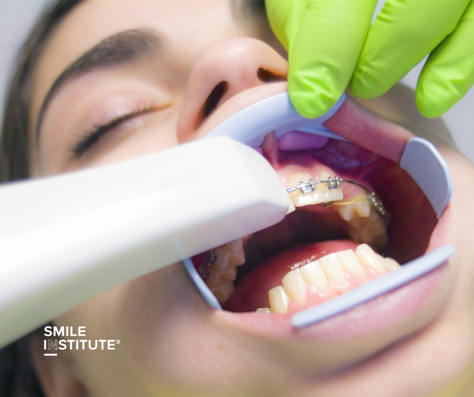 iTero szkenner – a fogszabályozás új dimenziója - Smile Institute Blog iTero szkenner – a fogszabályozás új dimenziója - Smile Institute Blog