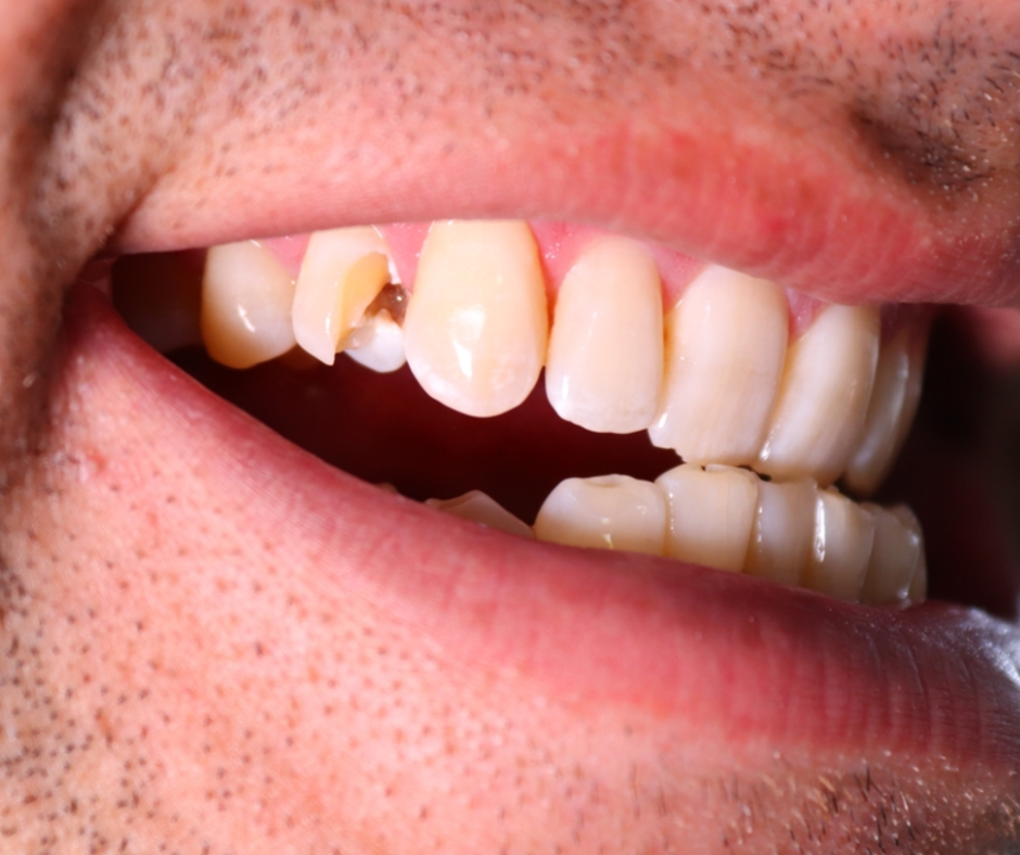 Külföldi utazás és fogászati vészhelyzetek – mit tegyen, ha baj történik? - Smile Institute Blog
