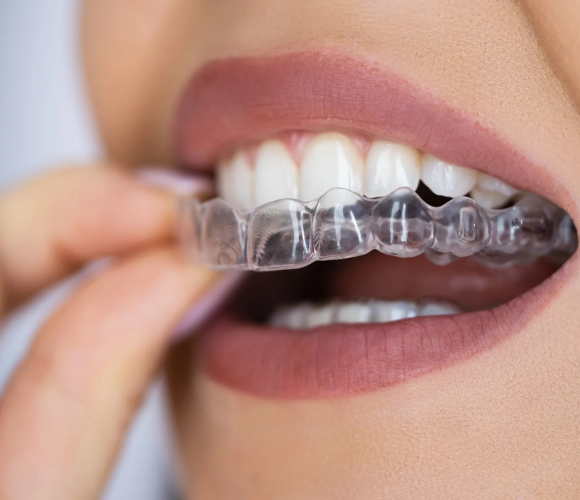 Smile Institute Budapest - Invisalign