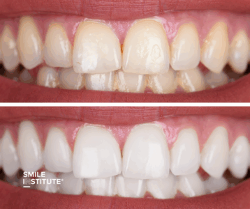 Mosoly esztétika és fogfehérítés: mit érdemes tudni, mire figyeljen, ha ragyogó mosolyt szeretne - Smile Institute Blog