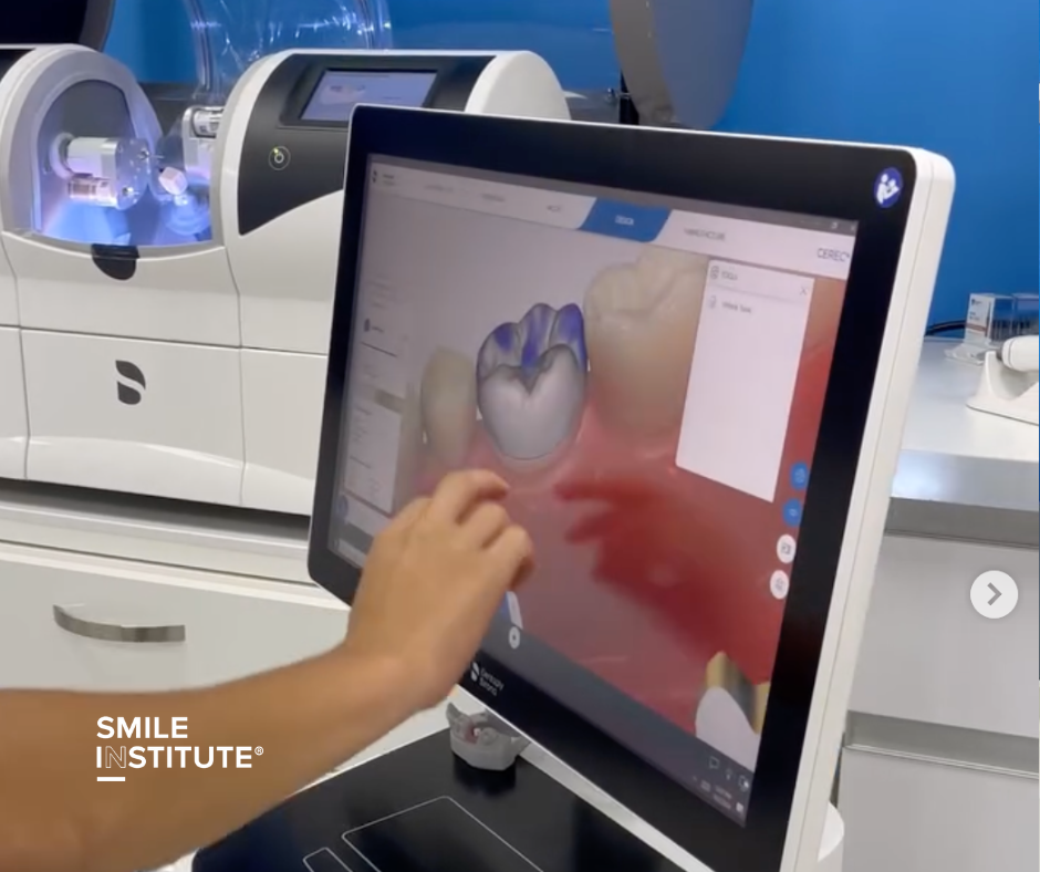 Digitális fogászat: Hogyan forradalmasítja a CAD/CAM & 3D-tervezés a fogpótlásokat és implantátumokat - Smile Institute Blog