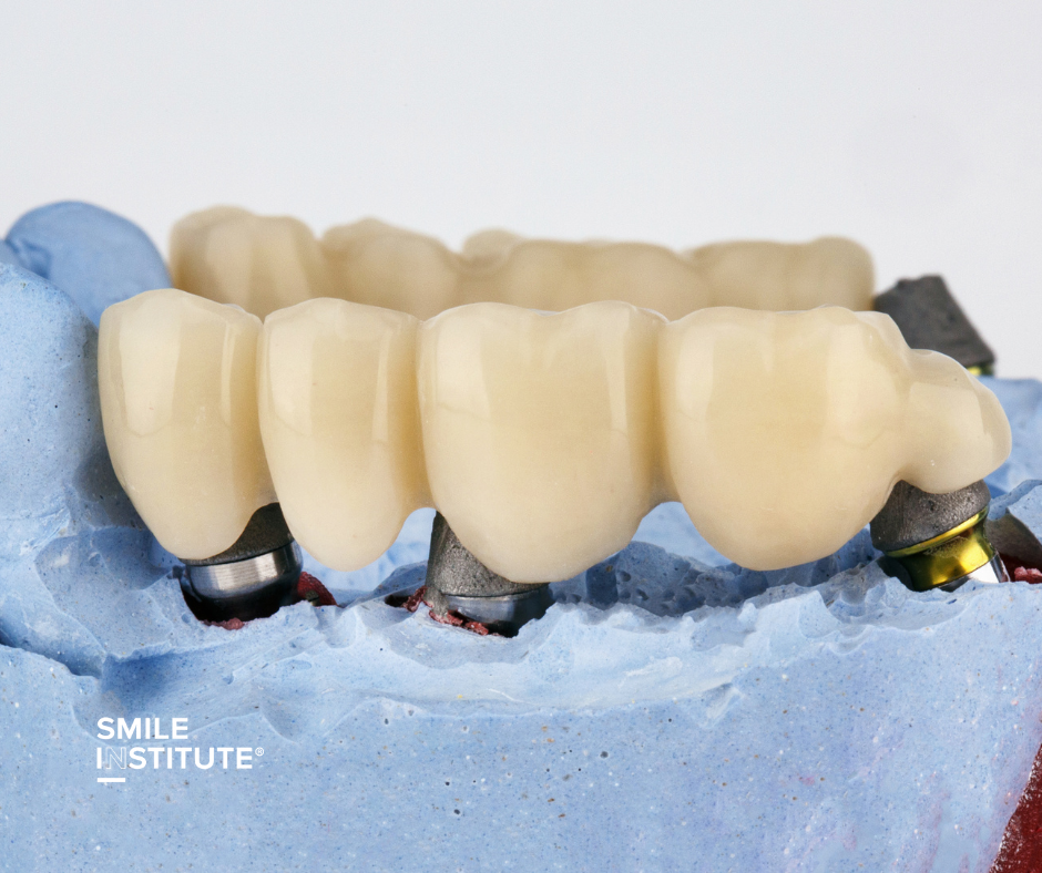 Implantátum vagy híd? Melyik a jobb választás? - Smile Institute Blog Implantátum vagy híd? Melyik a jobb választás? - Smile Institute Blog