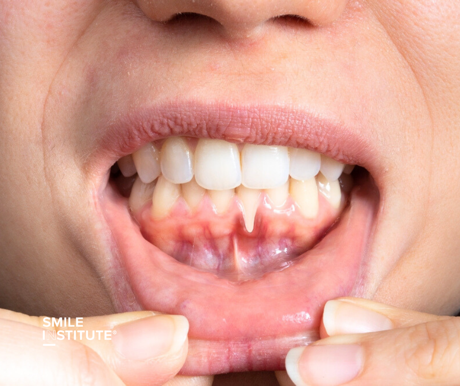 Reflux és fogzománc – hogyan védi meg fogait savas terhelés esetén? - Smile Institute Blog Reflux és fogzománc – hogyan védi meg fogait savas terhelés esetén? - Smile Institute Blog