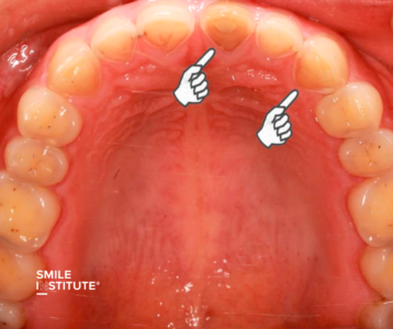 Reflux és fogzománc – hogyan védi meg fogait savas terhelés esetén? - Smile Institute Blog