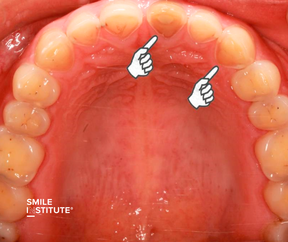 Reflux és fogzománc – hogyan védi meg fogait savas terhelés esetén? - Smile Institute Blog