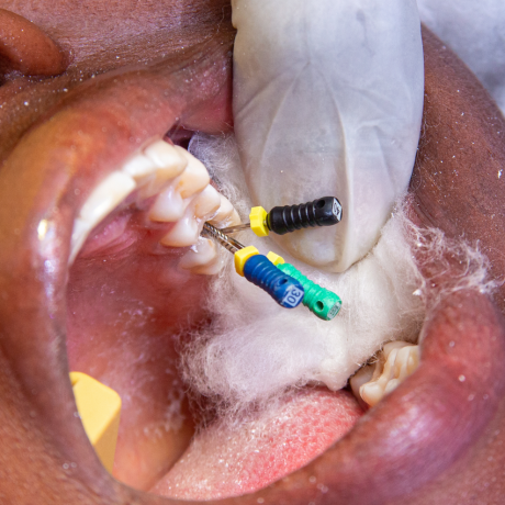 Mennyi ideig tart a gyökérkezelés? – Idő, alkalmak és gyógyulás - Smile Institute Blog Mennyi ideig tart a gyökérkezelés? – Idő, alkalmak és gyógyulás - Smile Institute Blog
