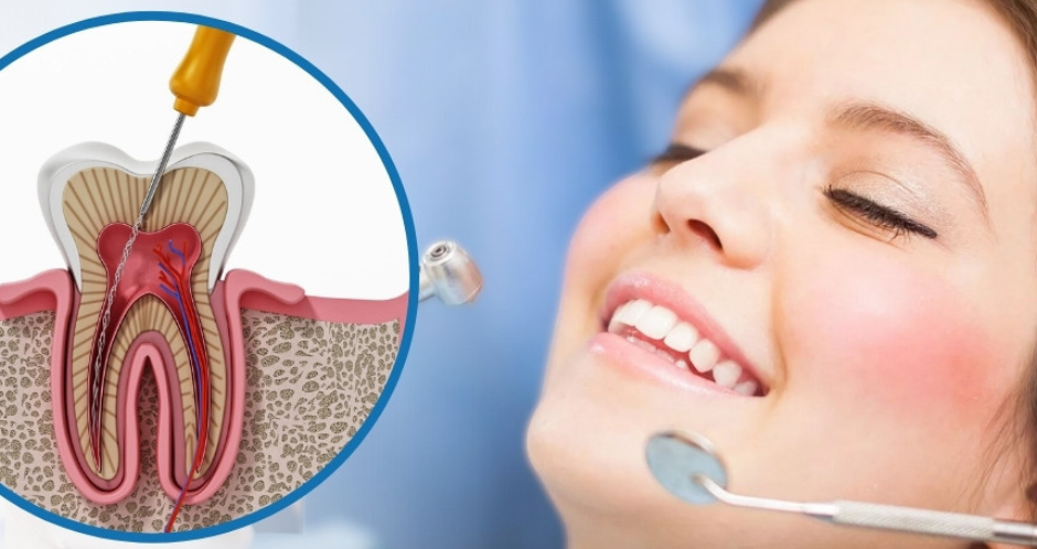 Fáj a gyökérkezelt fog? – Mit jelent, és mit lehet tenni? - Smile Institute Blog Fáj a gyökérkezelt fog? – Mit jelent, és mit lehet tenni? - Smile Institute Blog