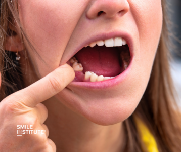 Miért lazulnak meg vagy esnek ki fogpótlások évekkel később? - Smile Institute Blog